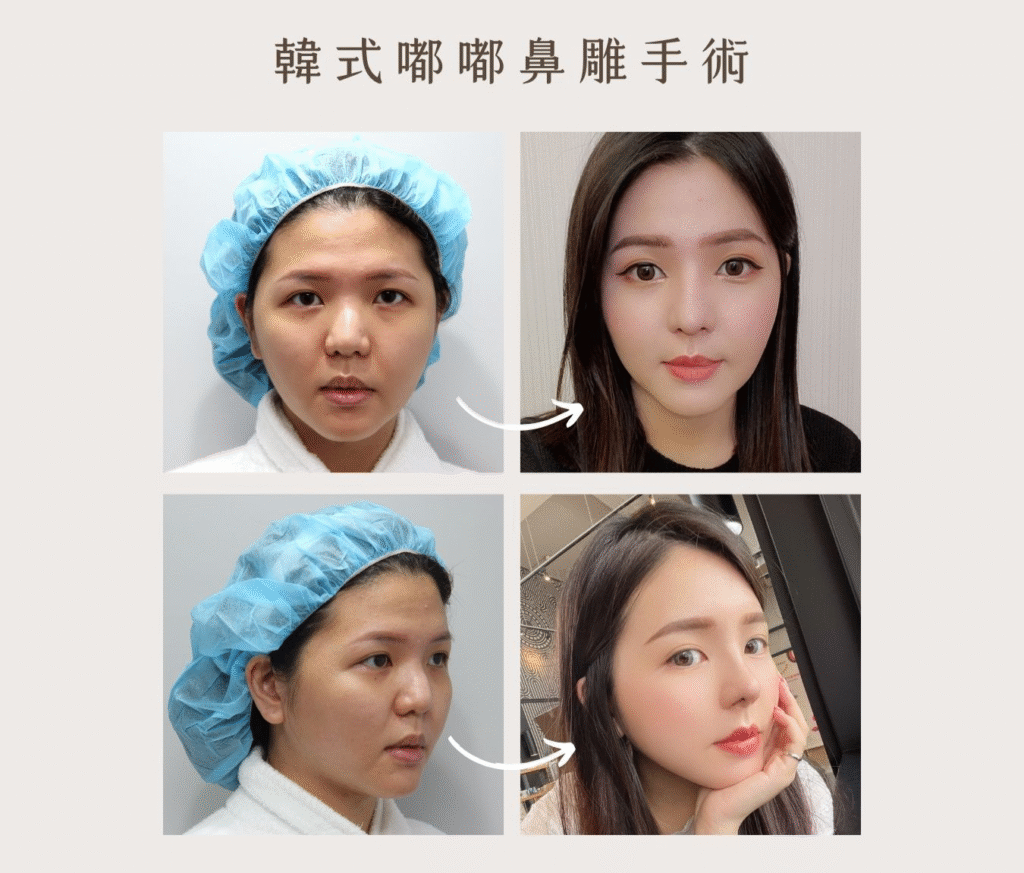 蒜頭鼻整形案例